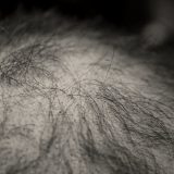 Haartransplantation-Alternativen